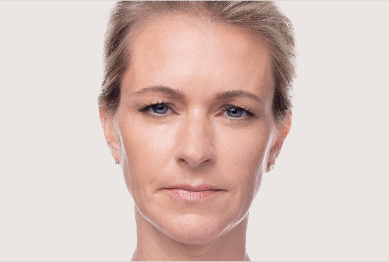 Patient 1 after Dysport treatment