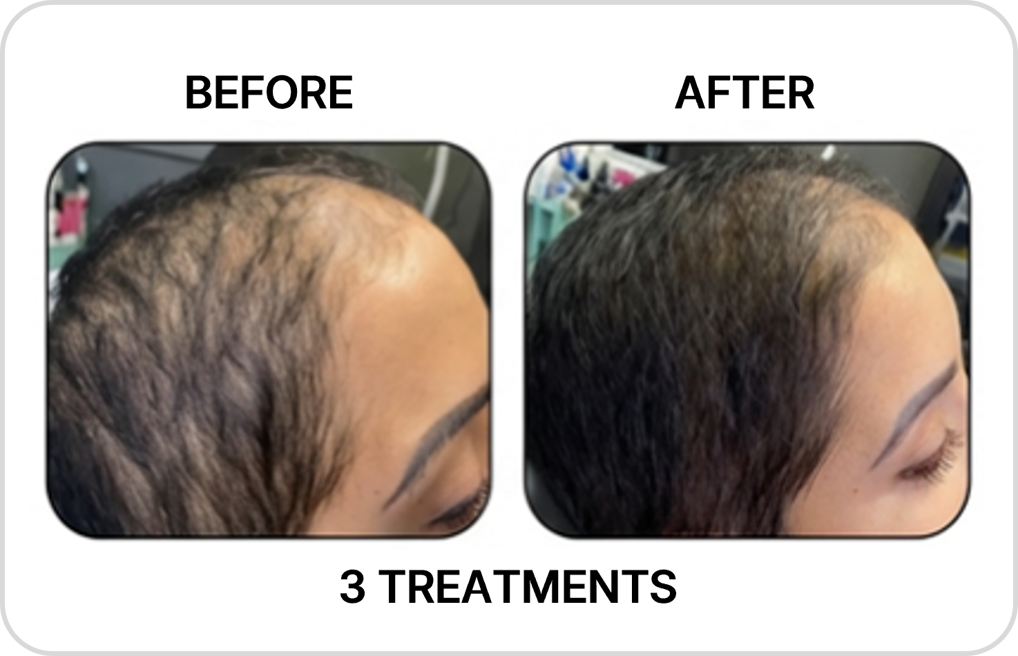 Body contouring before and after example 1