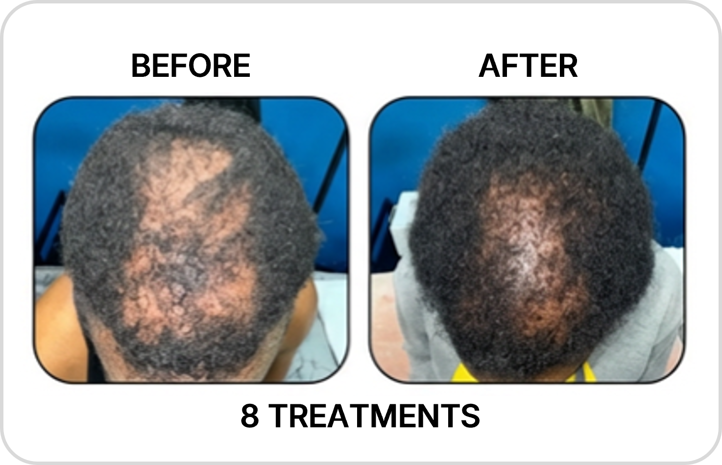 Body contouring before and after example 2
