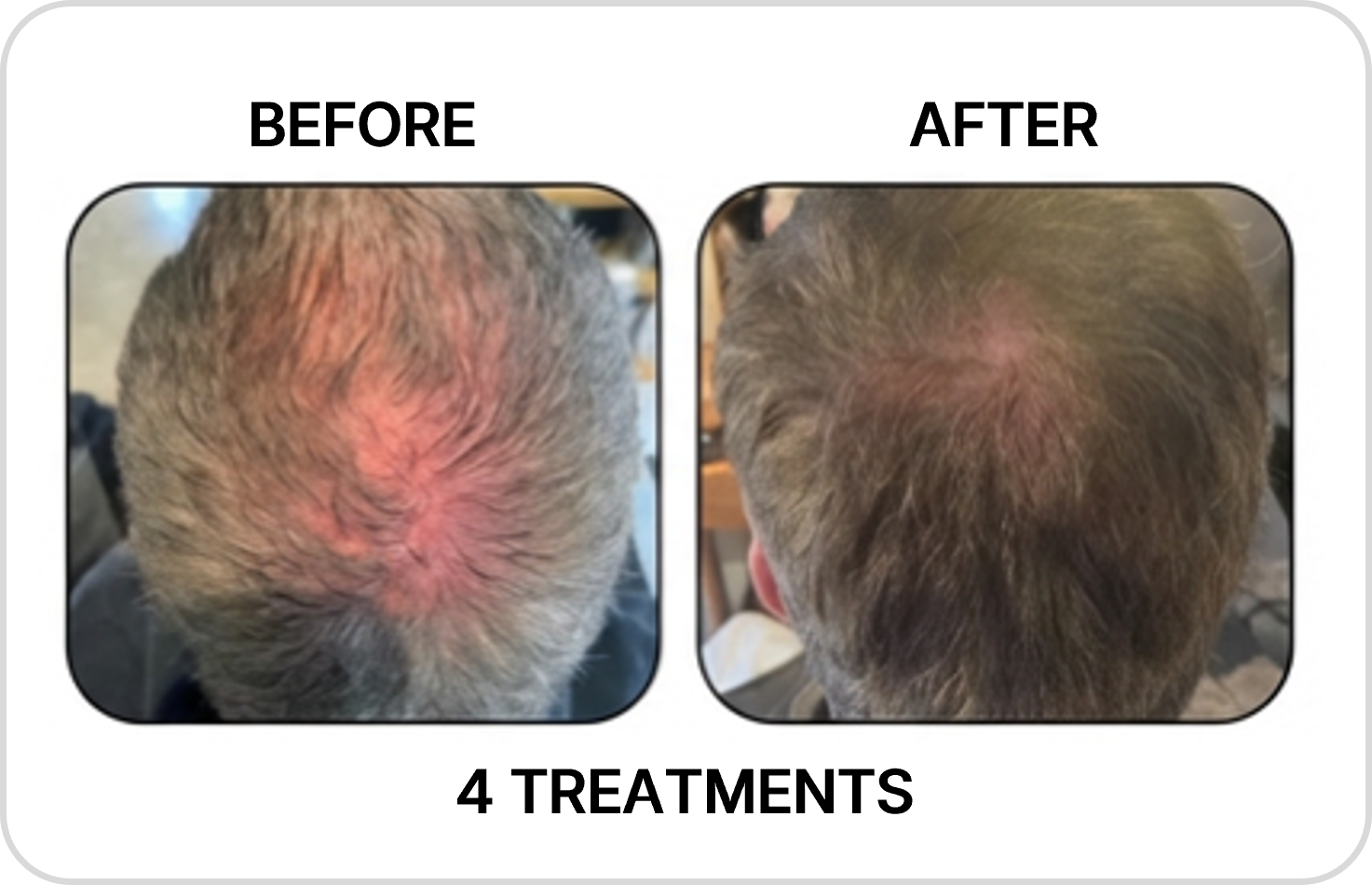 Body contouring before and after example 3